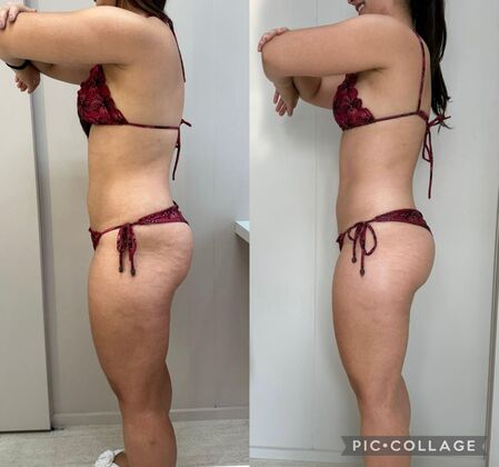 Resultado drenagem vibratória lateral esquerda - Dra. Anna Abreu